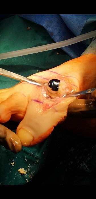 V novomeški bolnišnici prva implantacija umetnega sklepa v nožnem palcu v Sloveniji